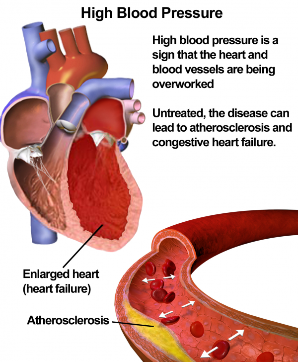 Blausen_0486_HighBloodPressure_01