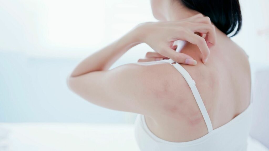 Eczema-Healthlivingyoga.com