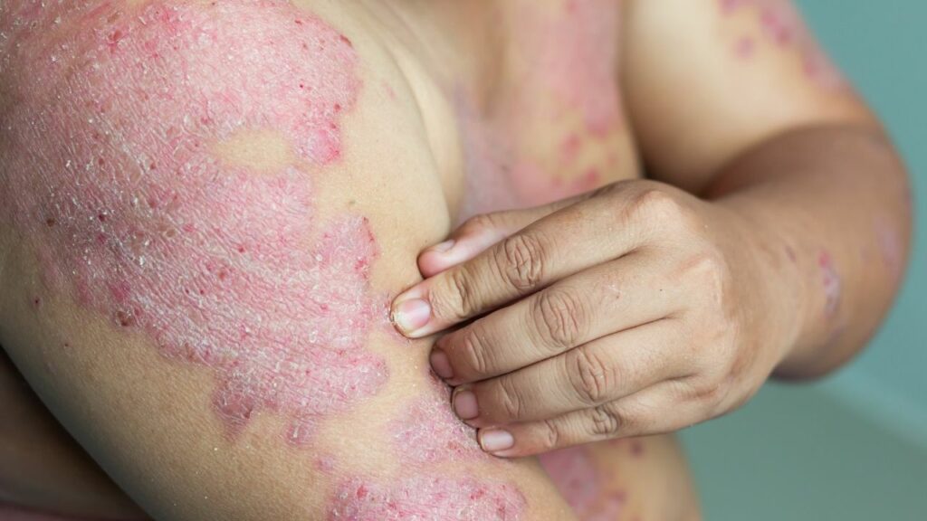 Eczema-Healthlivingyoga.com