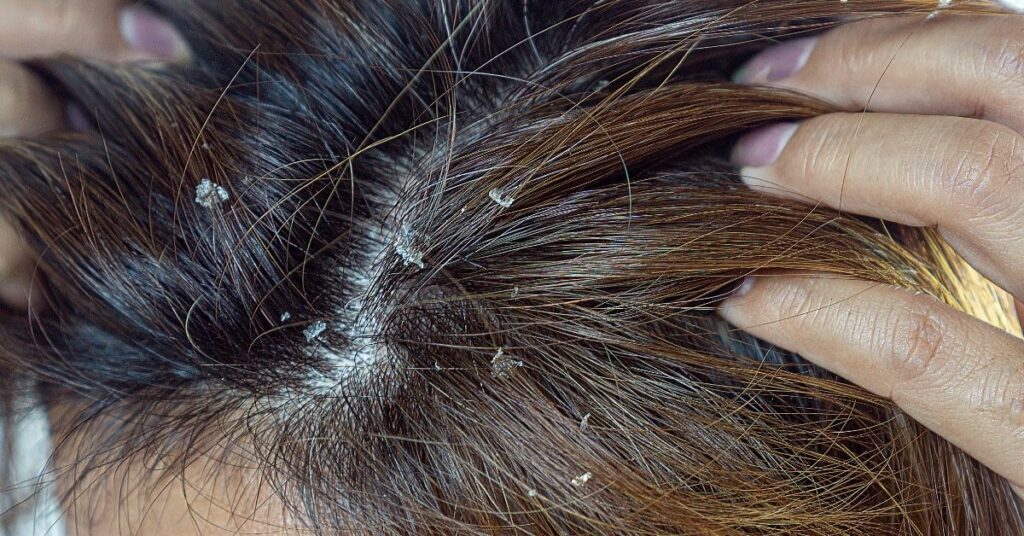 Home-Remedies-For-Dandruff-Healthlivingyoga.com